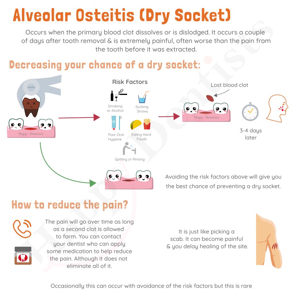 A Dry Socket - What is it, why does it happen, and how is it treated?