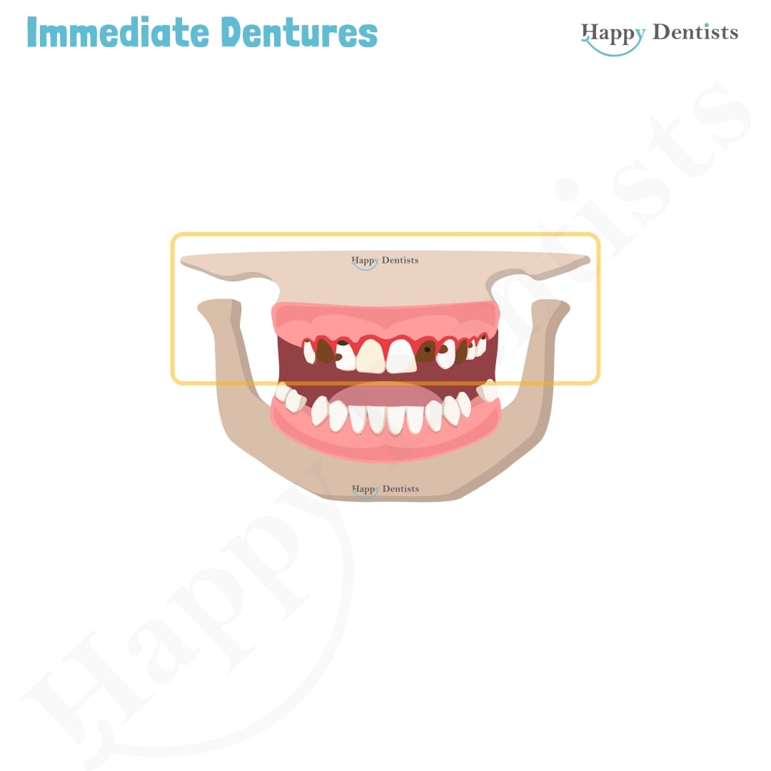 Immediate Dentures, Denture Animation