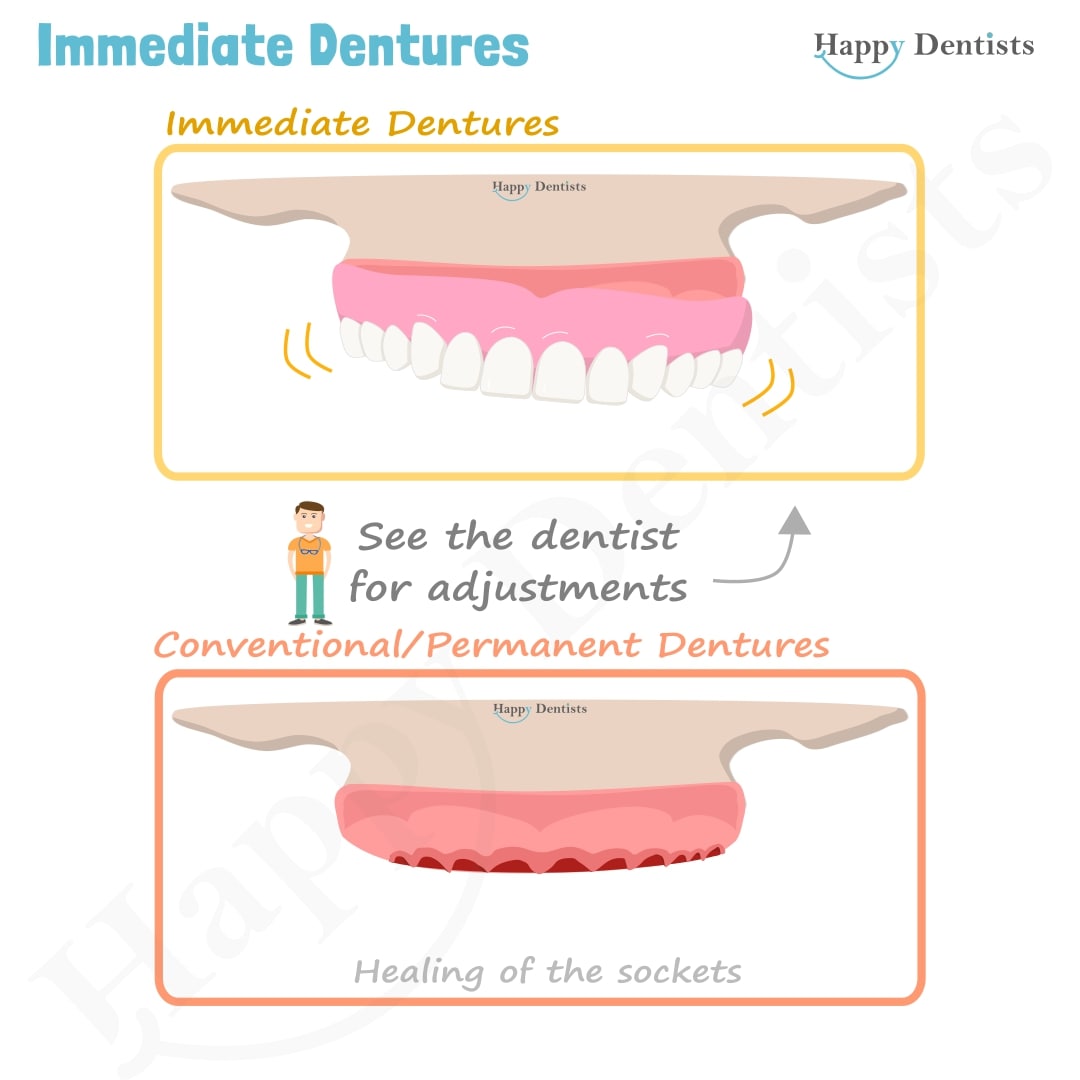 Immediate Dentures, Denture Animation