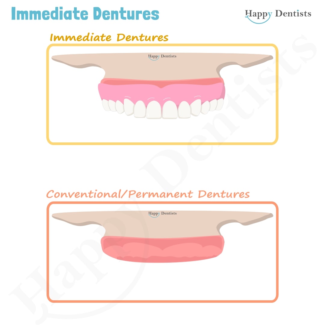 Immediate Dentures, Denture Animation