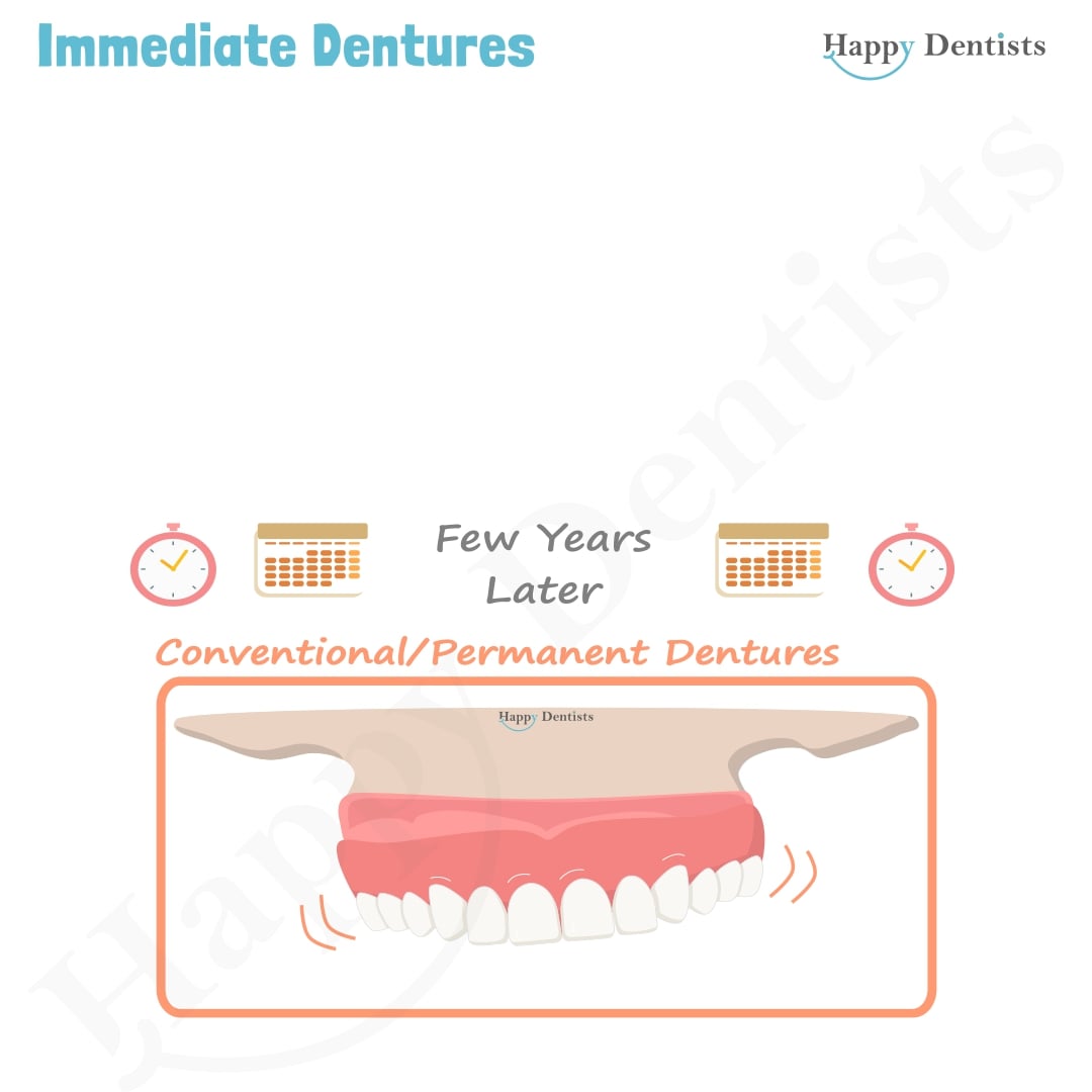 Immediate Dentures, Denture Animation