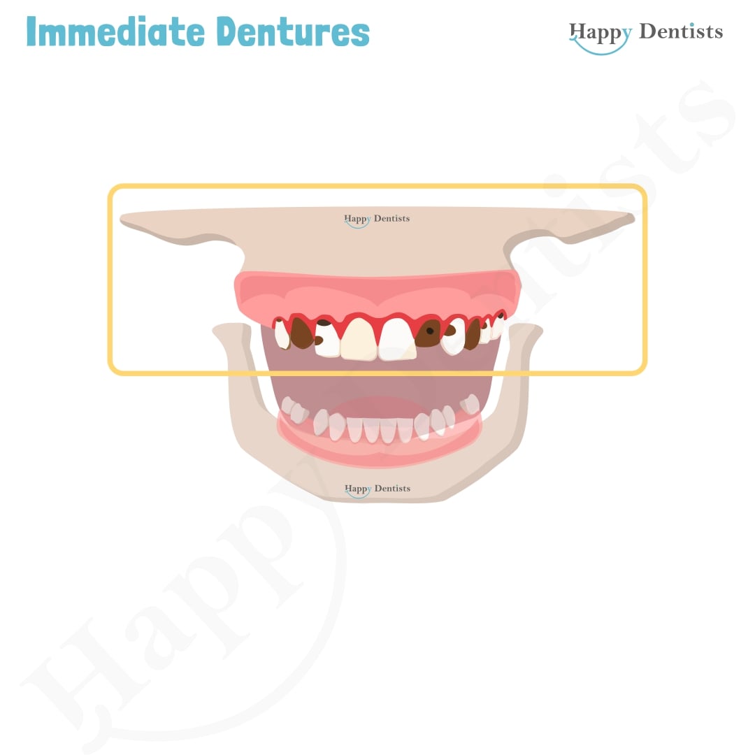 Immediate Dentures, Denture Animation