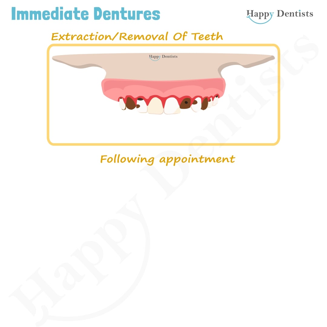 Immediate Dentures, Denture Animation