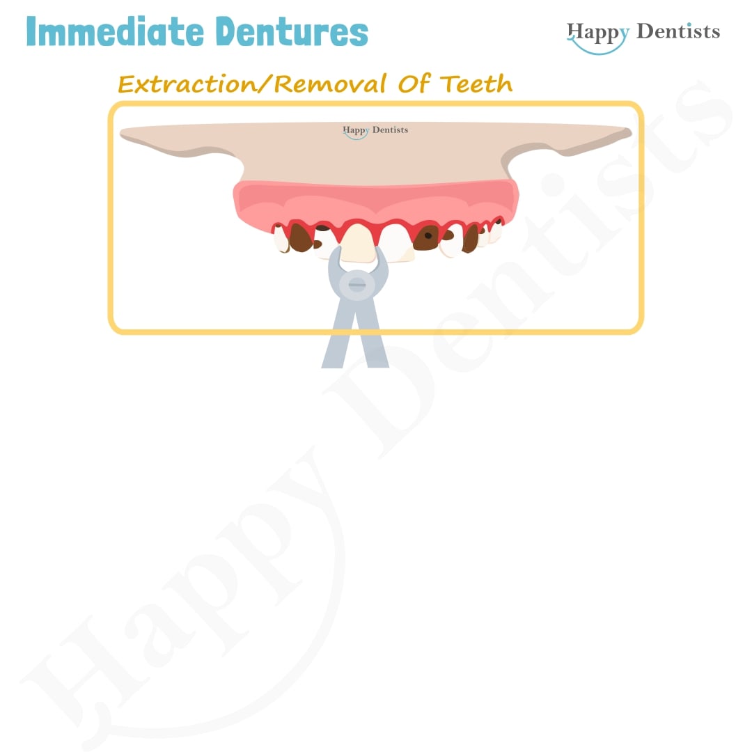 Immediate Dentures, Denture Animation