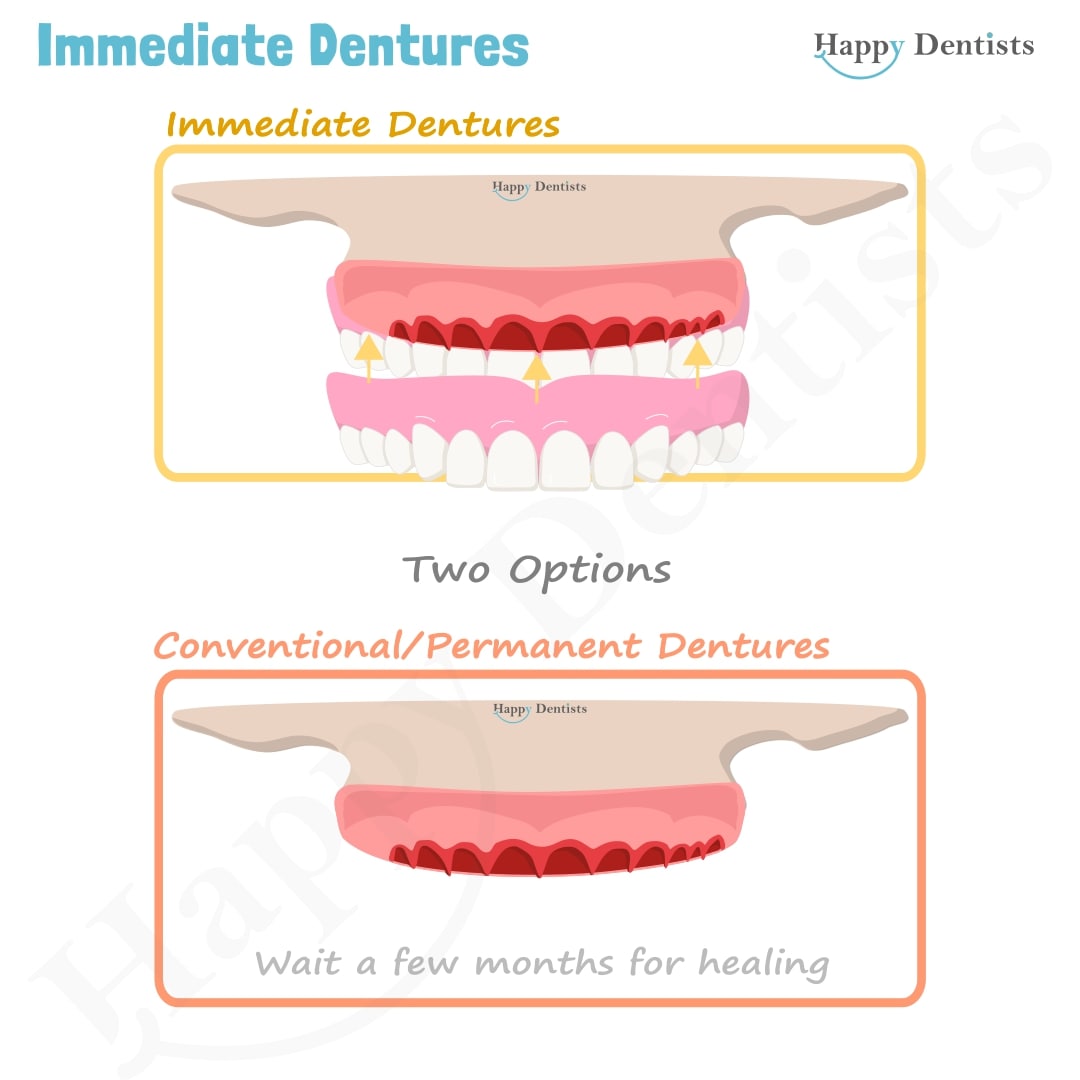 Immediate Dentures, Denture Animation
