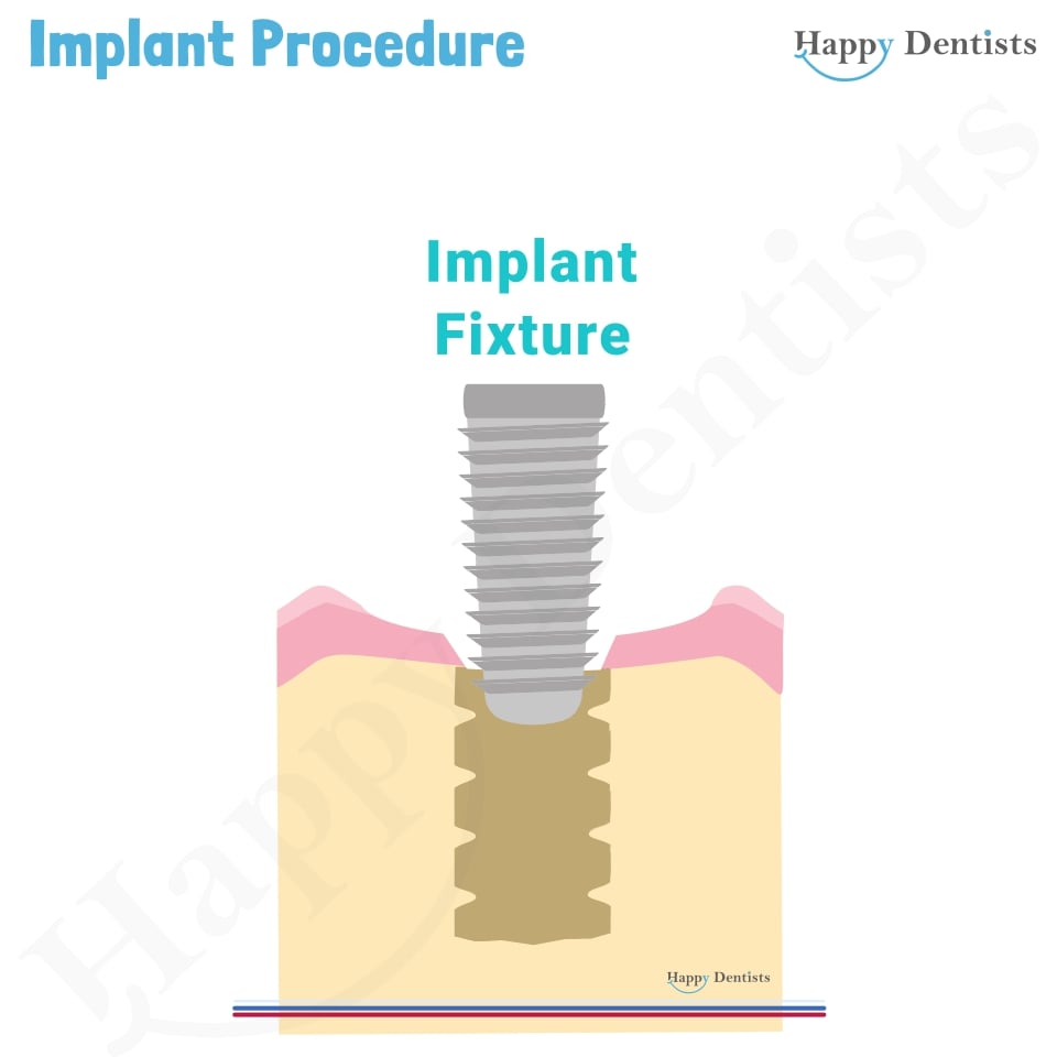 Implant Animation, Dental Implants