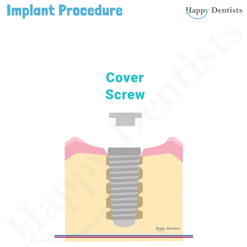 Implant Animation, Dental Implants