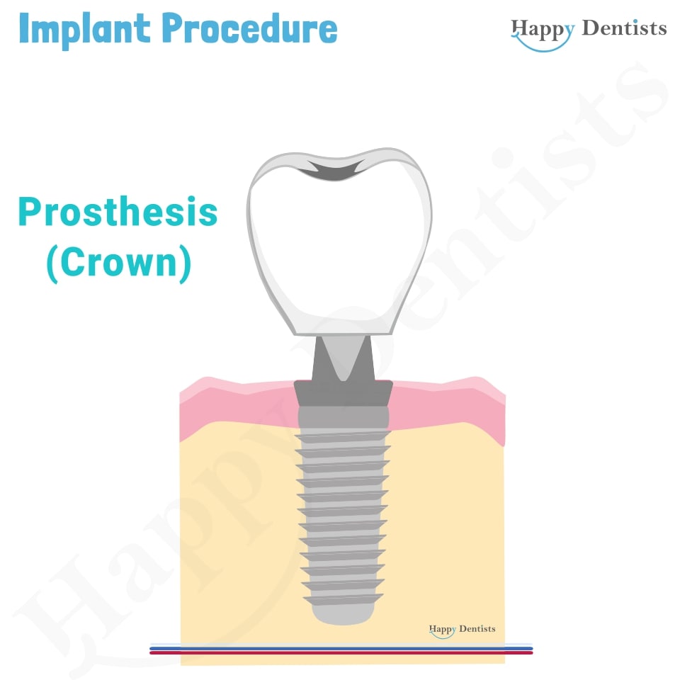 Implant Animation, Dental Implants