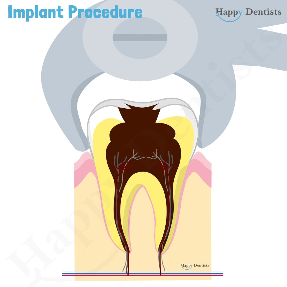 Implant Animation, Dental Implants