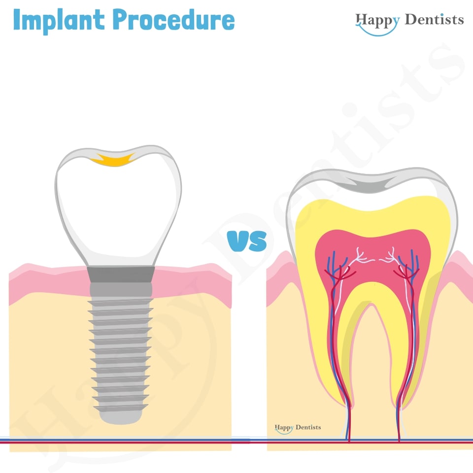 Implant Animation, Dental Implants