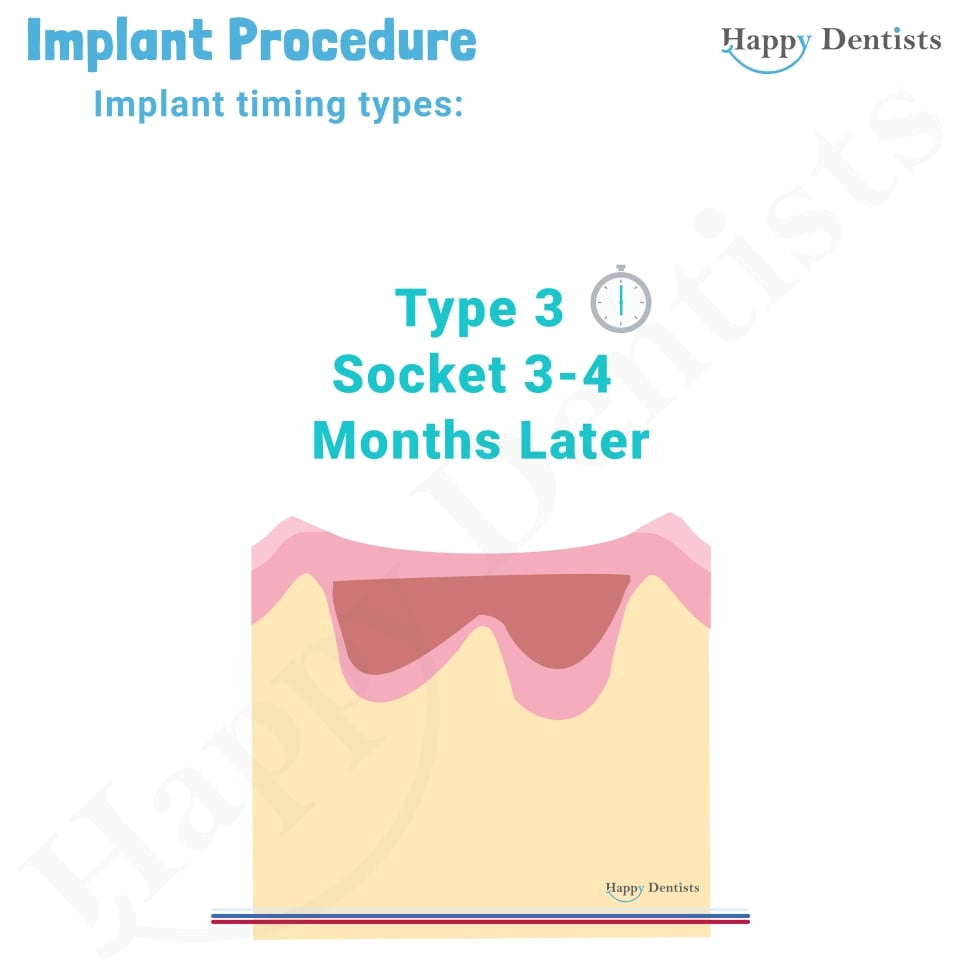 Implant Animation, Dental Implants