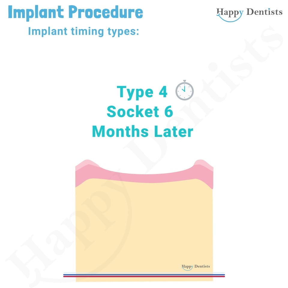 Implant Animation, Dental Implants