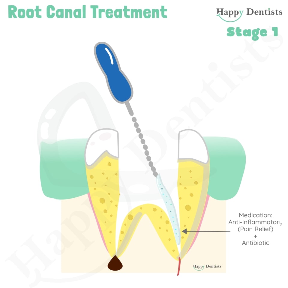 Root Canal Treatment Stages Animation, What is a Root Canal, Root canal treatment?, What is Root Canal treatment?