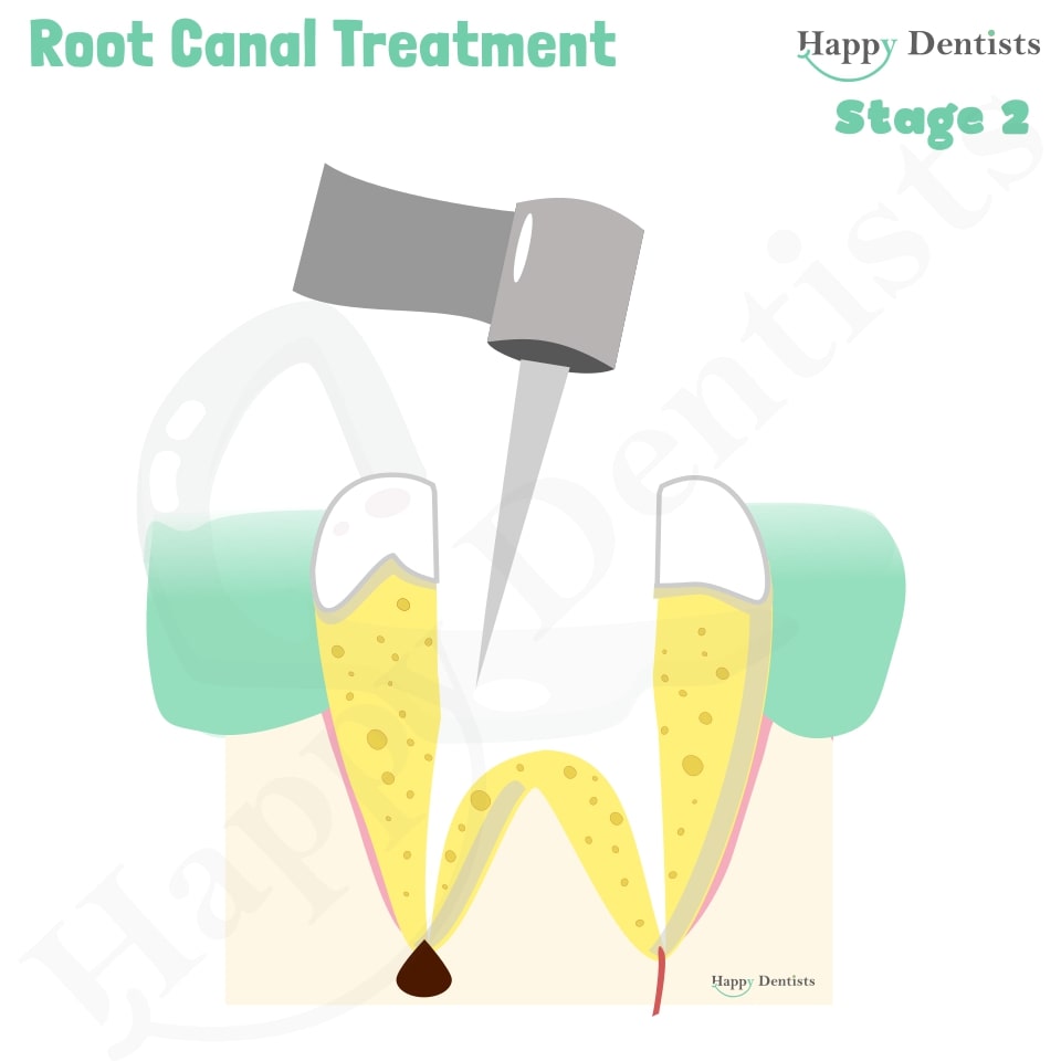 Root Canal Treatment Stages Animation, What is a Root Canal, Root canal treatment?, What is Root Canal treatment?