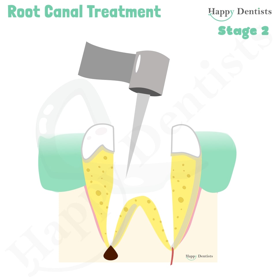 Root Canal Treatment Stages Animation, What is a Root Canal, Root canal treatment?, What is Root Canal treatment?