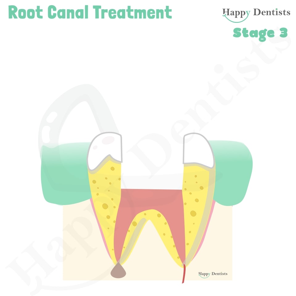 Root Canal Treatment Stages Animation, What is a Root Canal, Root canal treatment?, What is Root Canal treatment?