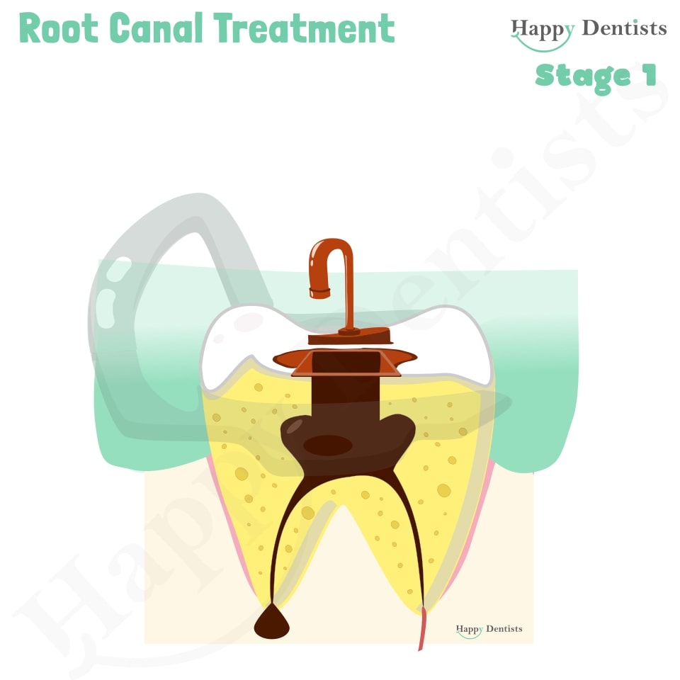 Root Canal Treatment Stages Animation, What is a Root Canal, Root canal treatment?, What is Root Canal treatment?