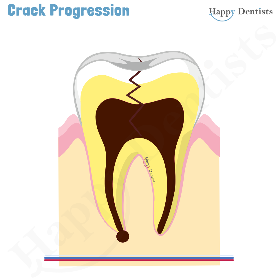 Crack tooth, Tooth Crack Animation