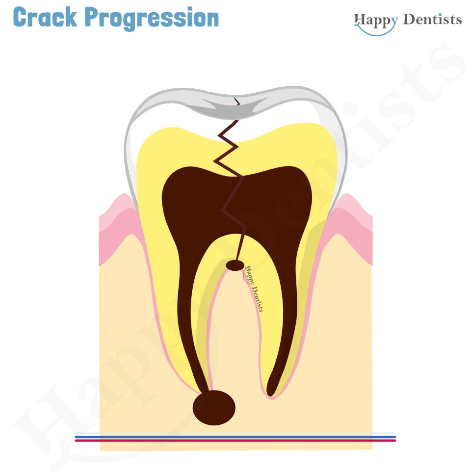 Crack tooth, Tooth Crack Animation