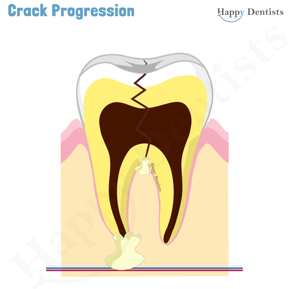 Crack tooth, Tooth Crack Animation