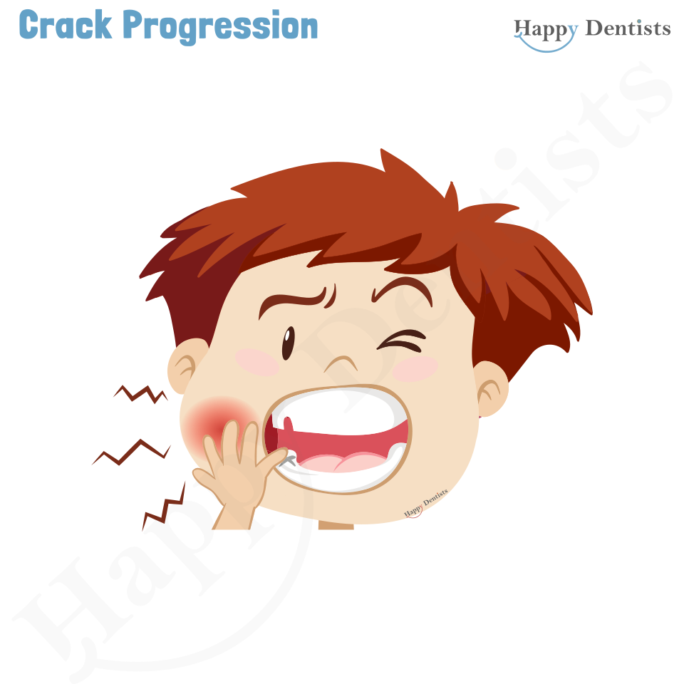 Crack tooth, Tooth Crack Animation