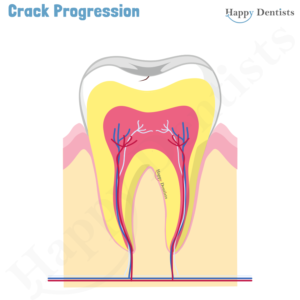 Crack tooth, Tooth Crack Animation