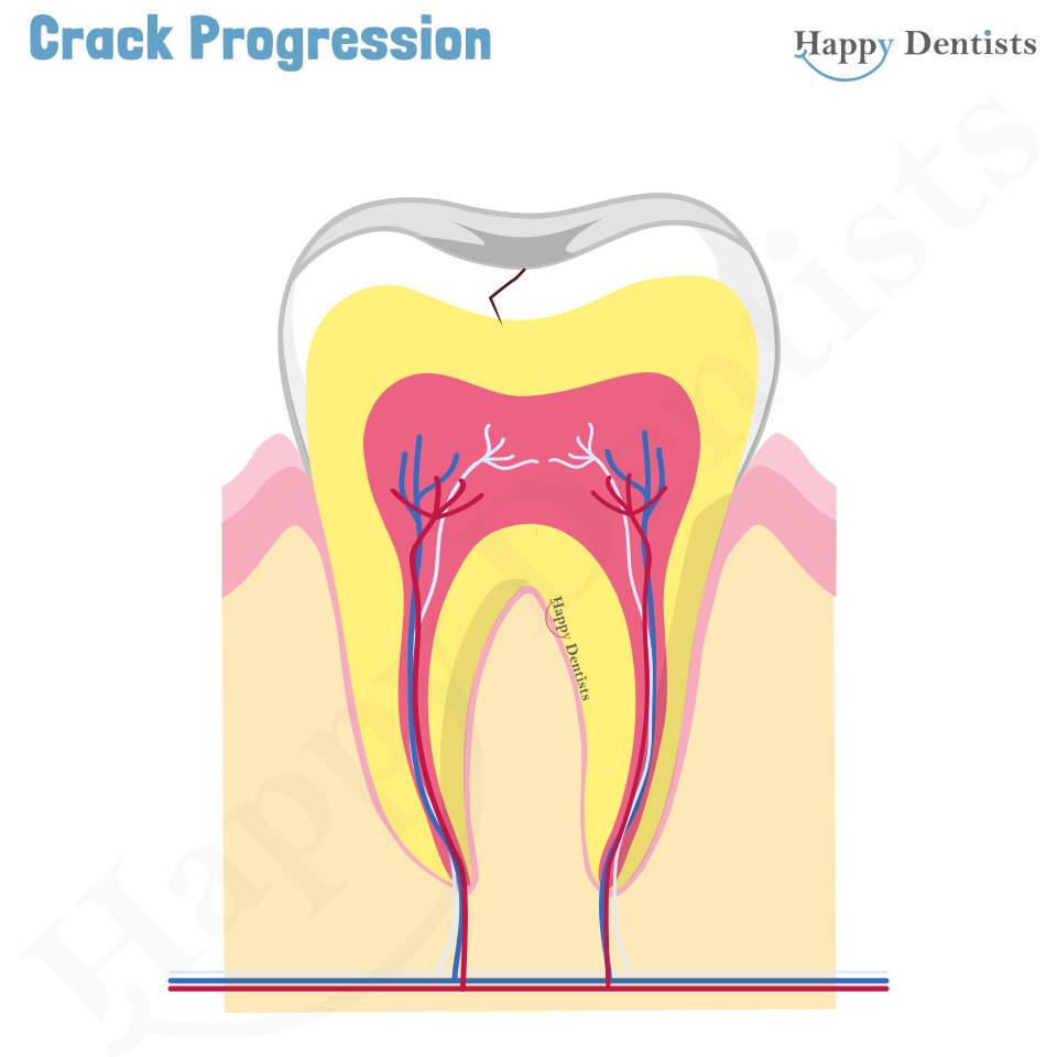 Crack tooth, Tooth Crack Animation