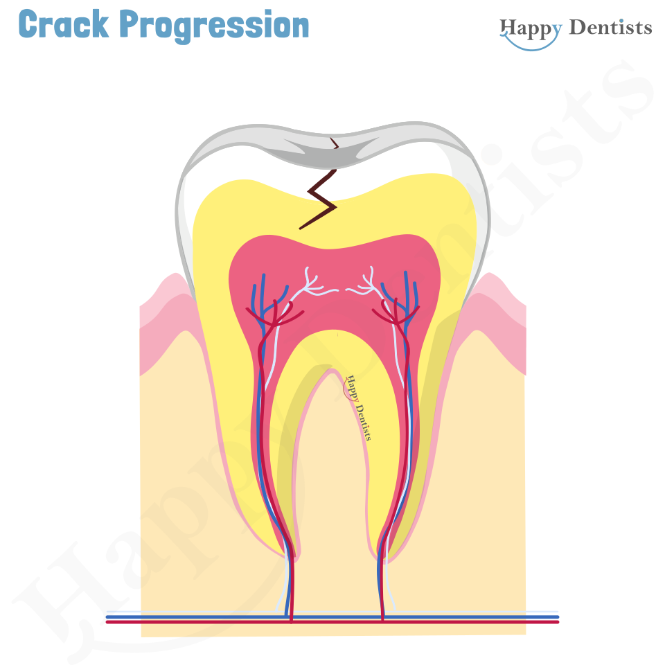 Crack tooth, Tooth Crack Animation