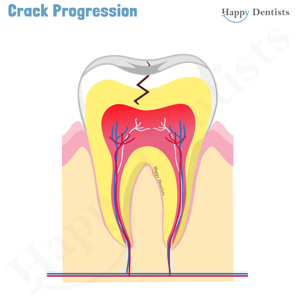 Crack tooth, Tooth Crack Animation