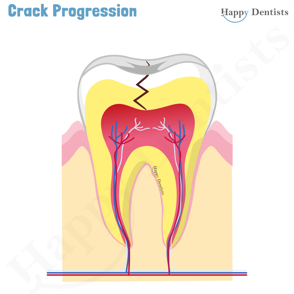 Crack tooth, Tooth Crack Animation