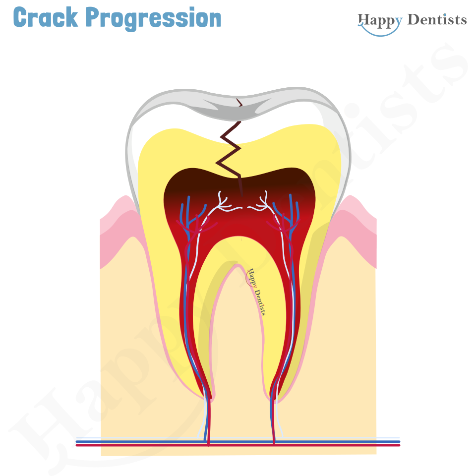 Crack tooth, Tooth Crack Animation