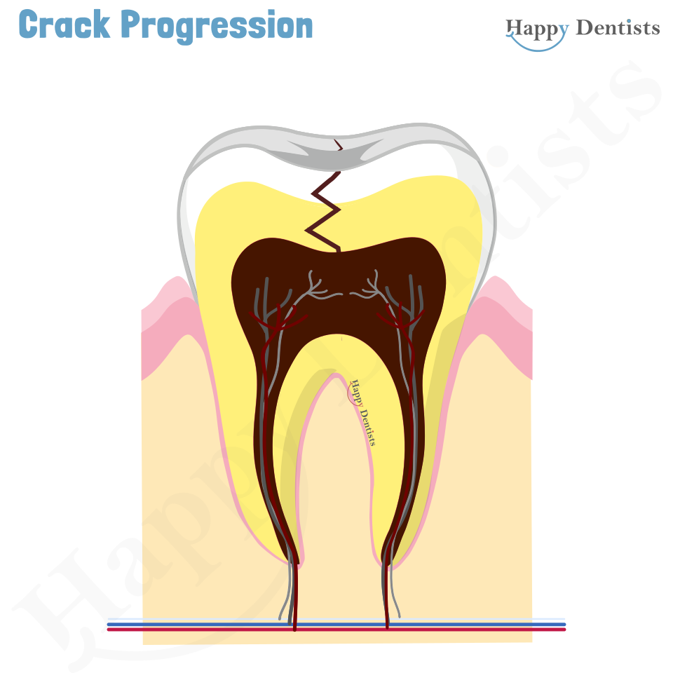 Crack tooth, Tooth Crack Animation