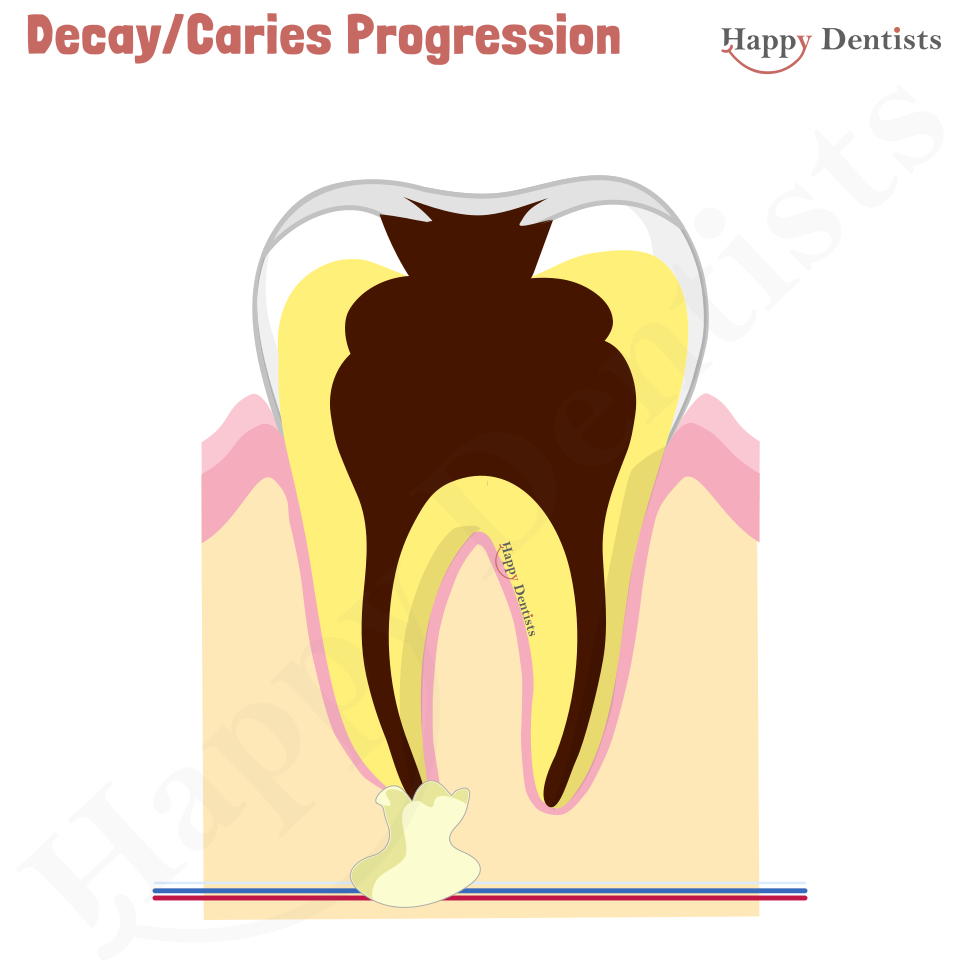 Dental Decay, Caries Animation