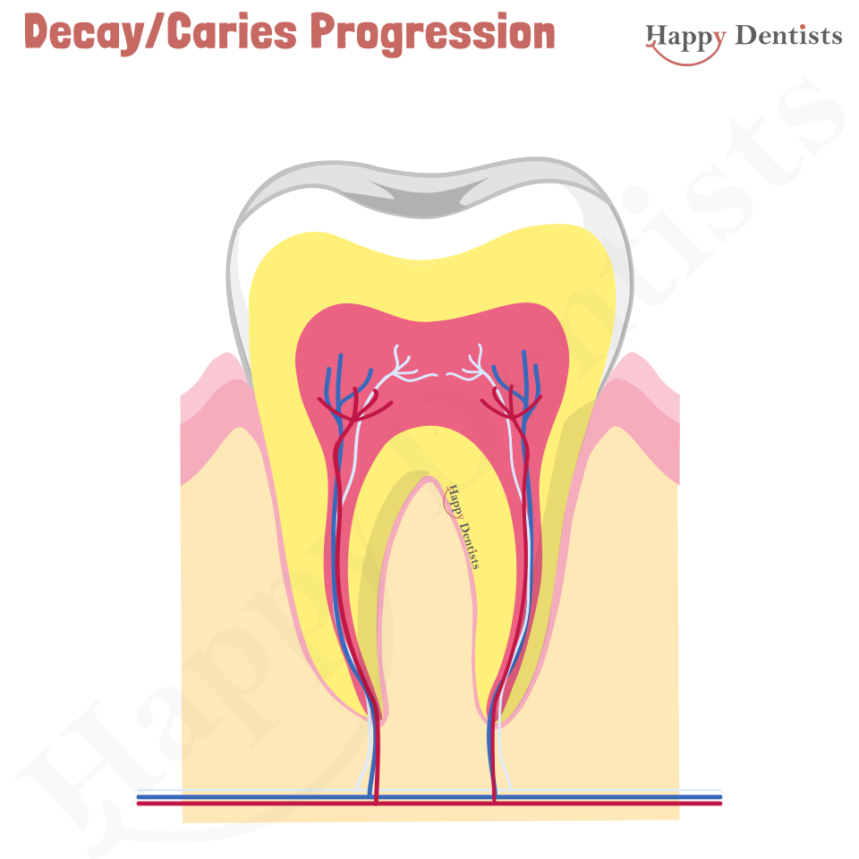 Dental Decay, Caries Animation