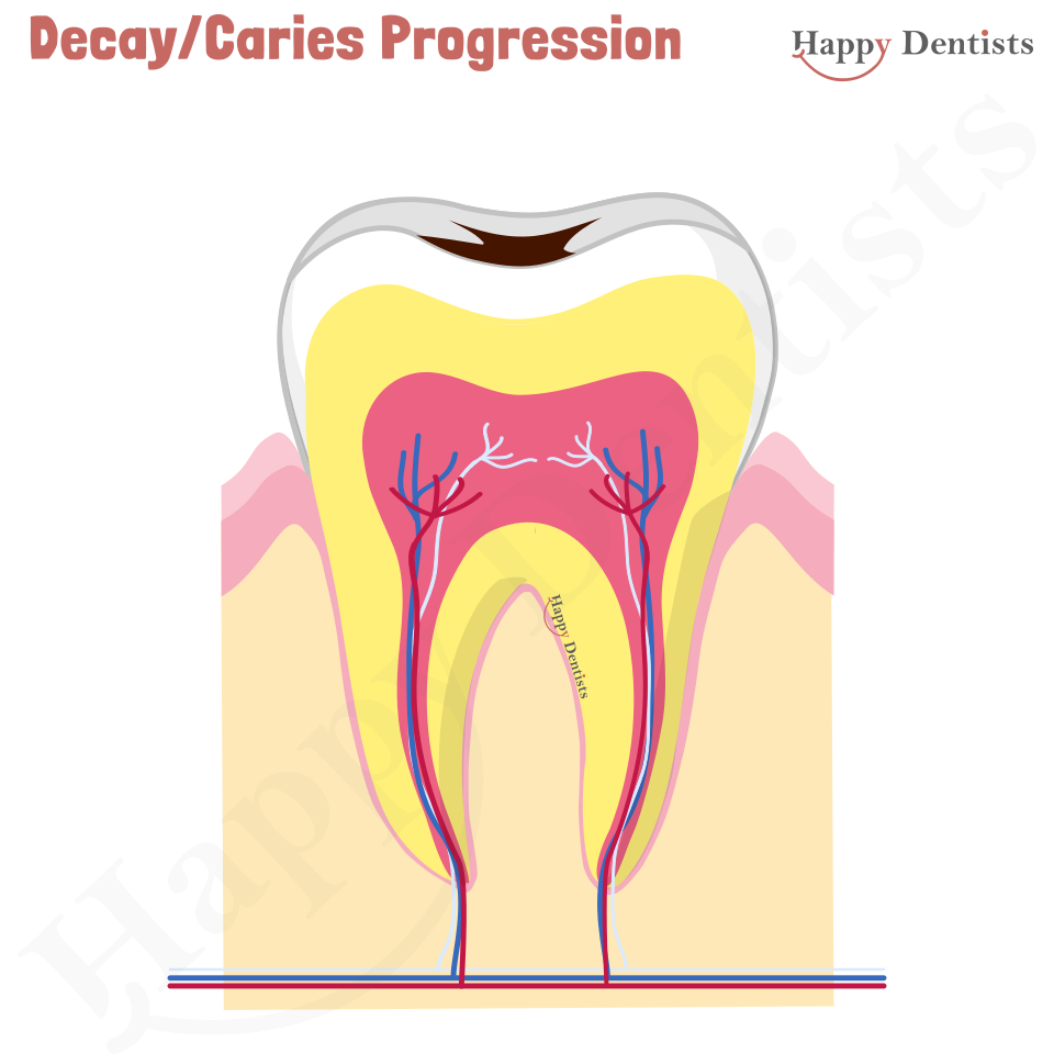 dental caries progression