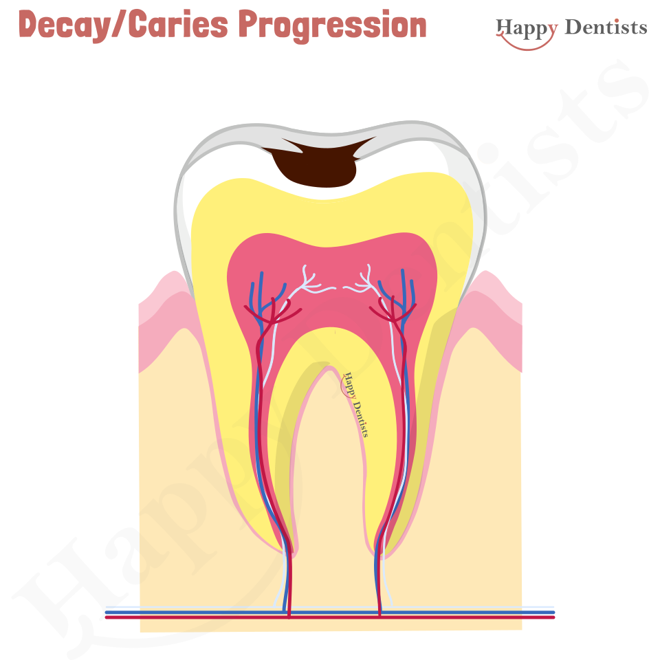 Dental Decay, Caries Animation