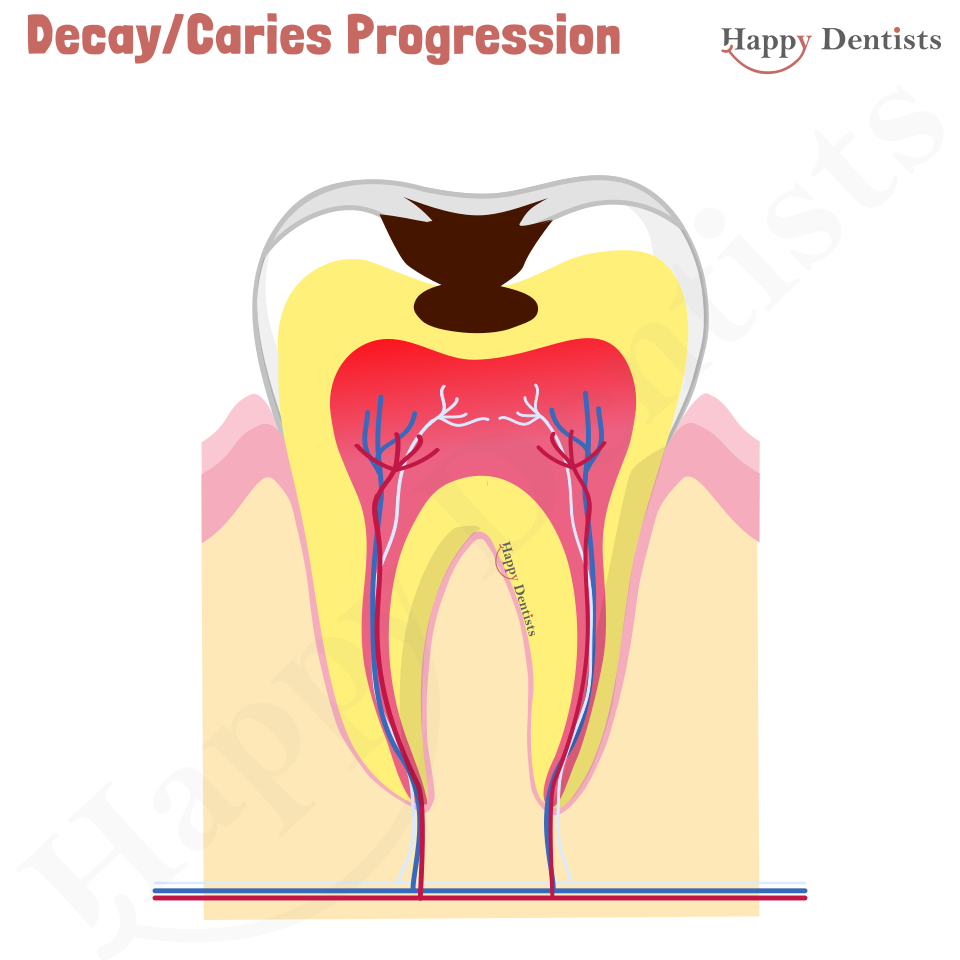 Dental Decay, Caries Animation