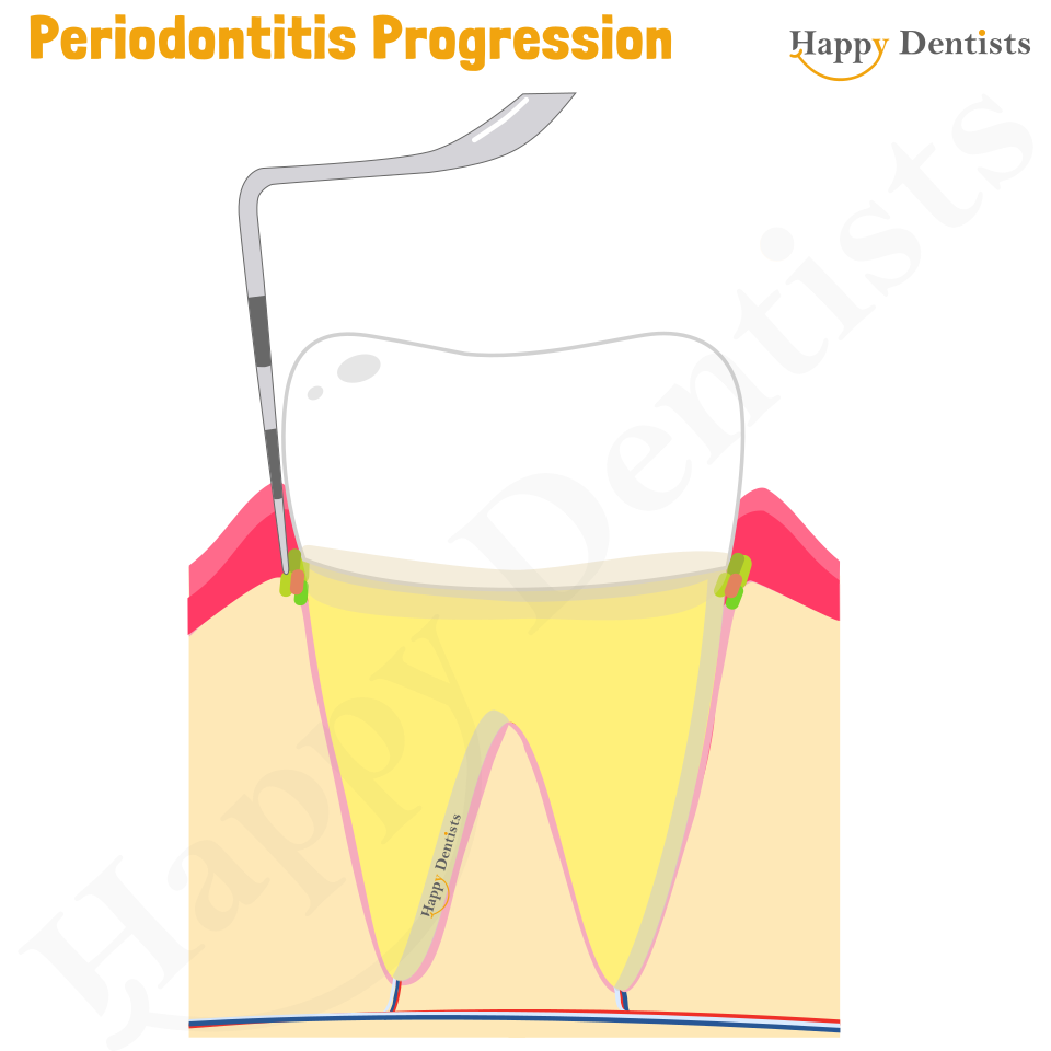 Periodontitis Animation, Periodontitis, Gum Disease