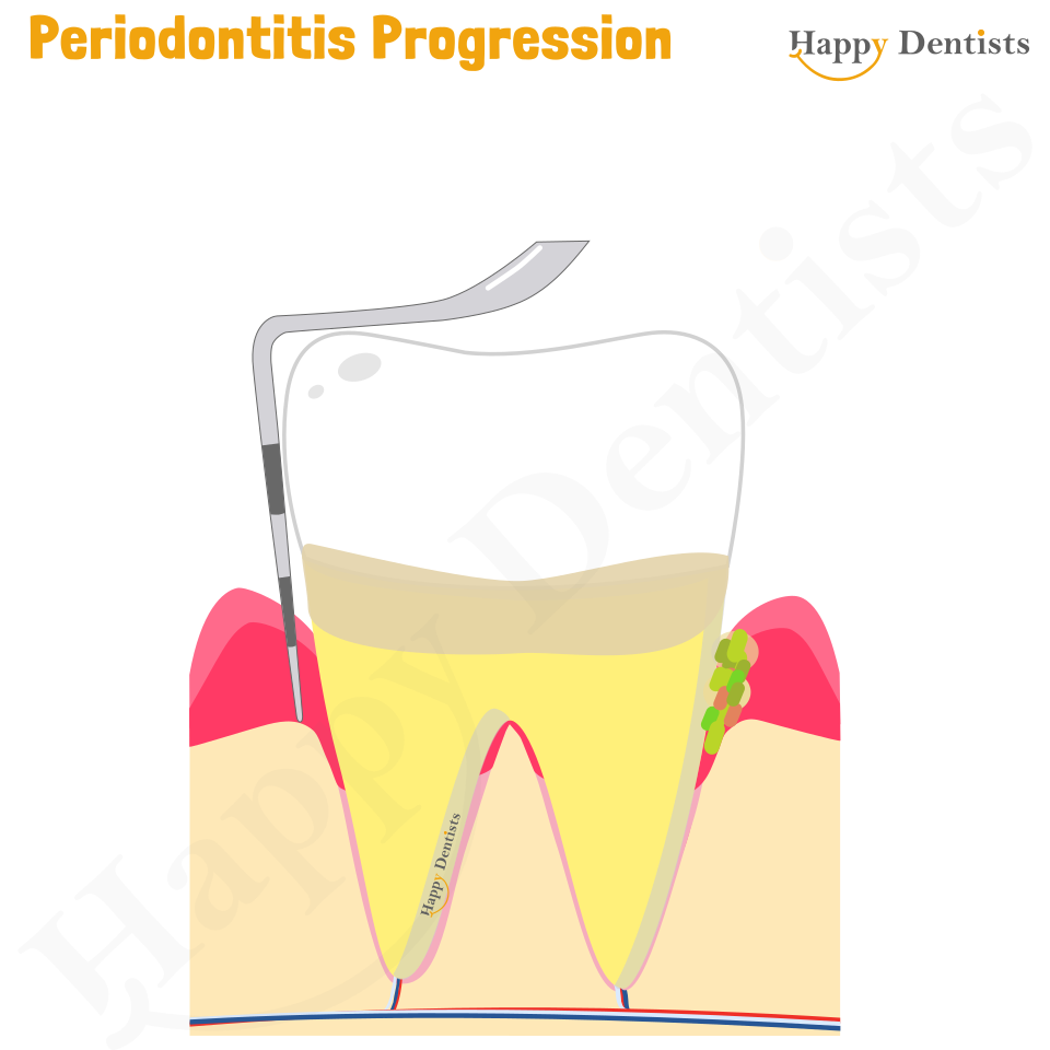 Periodontitis Animation, Periodontitis, Gum Disease